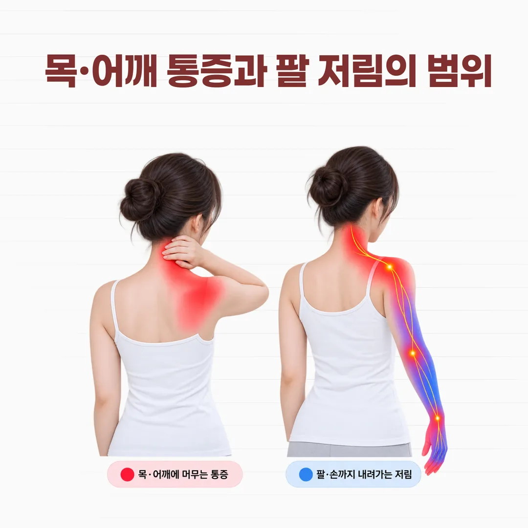 목에서 어깨까지 멈추는 통증과 팔·손으로 내려가는 저림의 범위 비교
