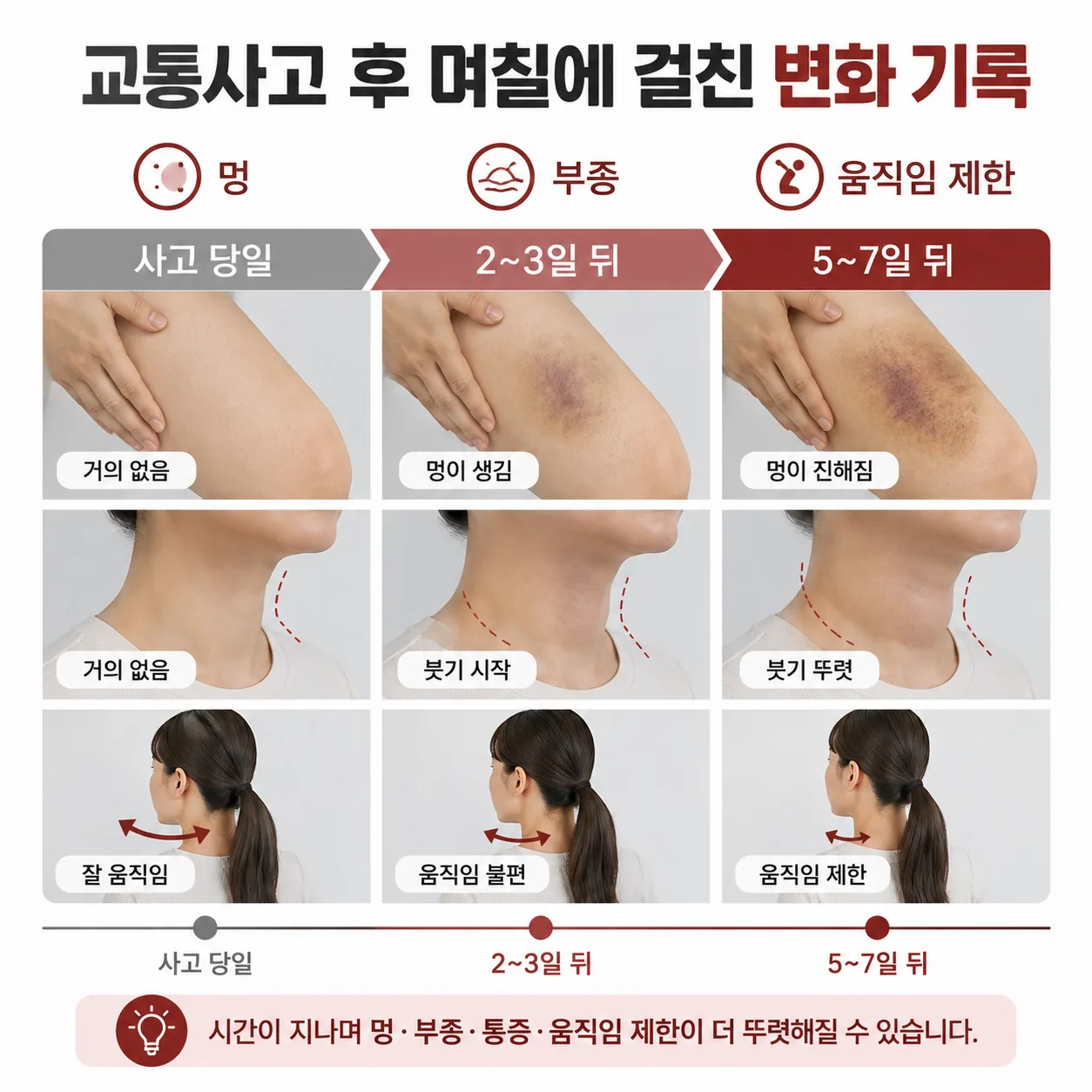 사고 후 며칠간 멍과 부종, 움직임 제한 변화를 기록한 콘셉트 이미지