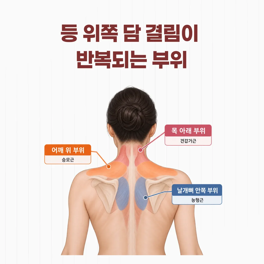 등 위쪽 담 결림이 반복되는 부위 구분 그림