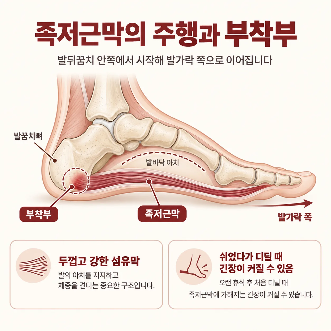 족저근막의 주행과 발꿈치뼈 부착부를 표시한 개념도