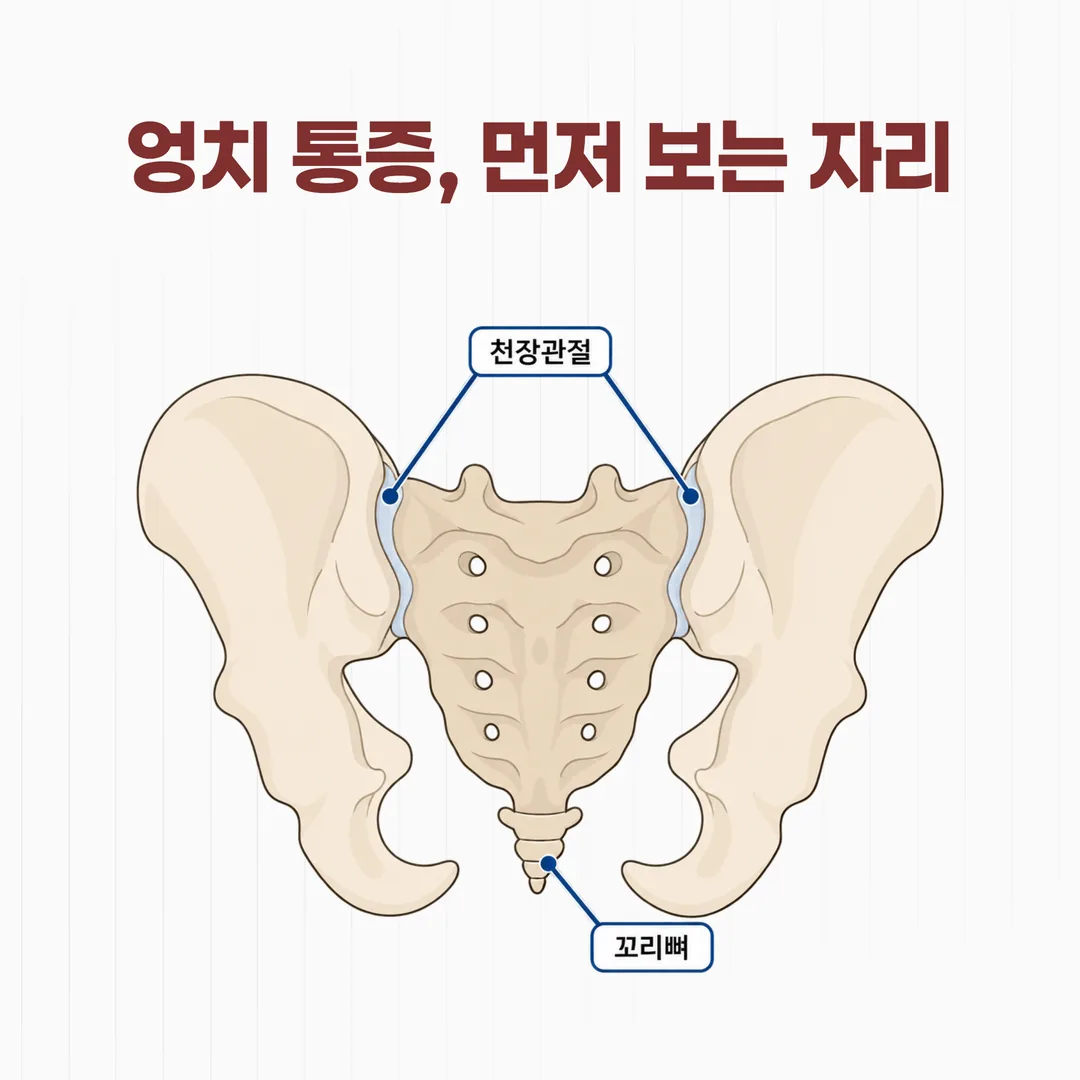 천장관절과 꼬리뼈의 위치를 표시한 골반 뒤쪽 구조 개념도