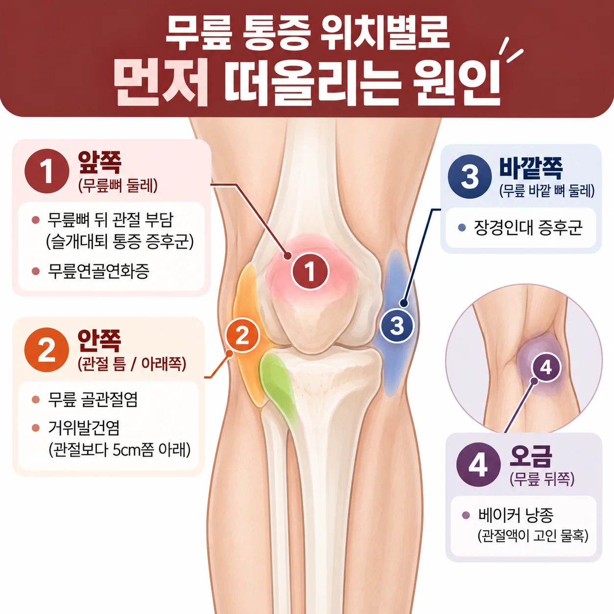 무릎 앞쪽 안쪽 바깥쪽 오금 통증 위치별 원인 지도