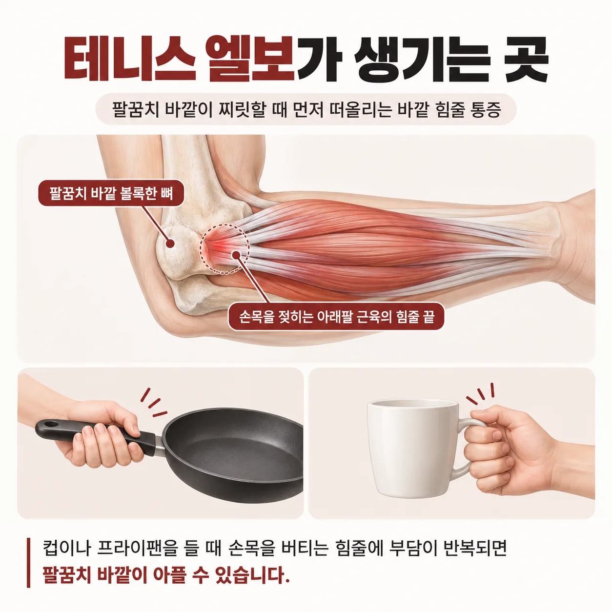 팔꿈치 바깥 볼록한 뼈와 손목 젖히는 근육의 힘줄 끝을 색으로 표시한 테니스 엘보 개념도