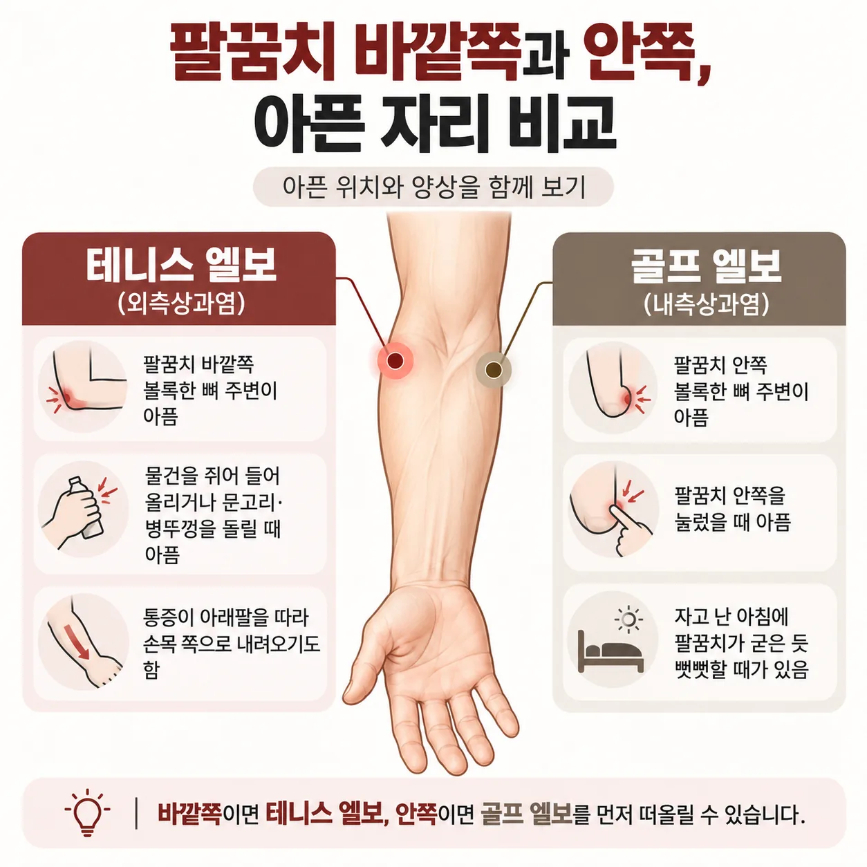 팔꿈치 바깥쪽 테니스 엘보와 안쪽 골프 엘보의 아픈 자리 비교 그림