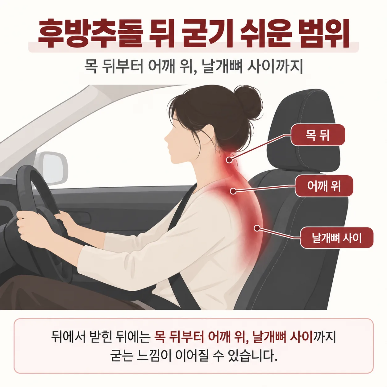 후방추돌 뒤 목에서 어깨 위와 날개뼈 사이로 이어지는 굳는 범위 개념도