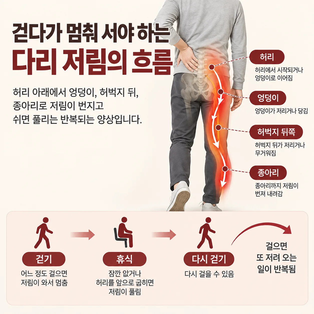척추관협착증에서 걸을 때 엉덩이부터 종아리까지 저림이 번지고 쉬면 풀리는 흐름 개념도